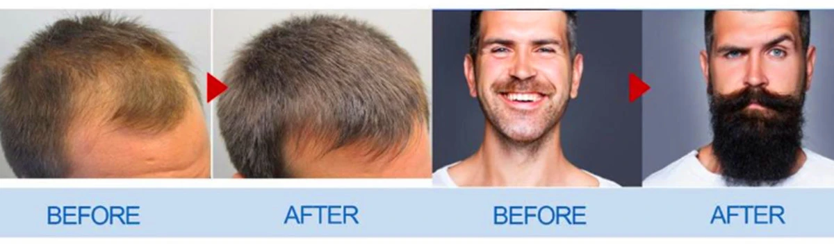 Minoxidil for hair Minoxidil for hair